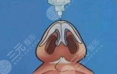 濡白天使打鼻子多久定型？濡白天使維持時(shí)間、價(jià)格、優(yōu)勢(shì)科普