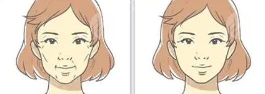 筋膜提拉術(shù)之后需要注意什么?