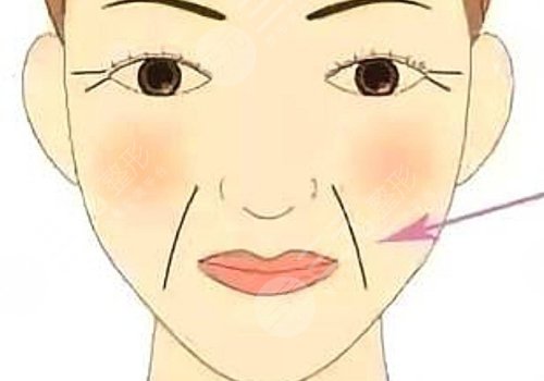 法令紋太深了有什么解決辦法？