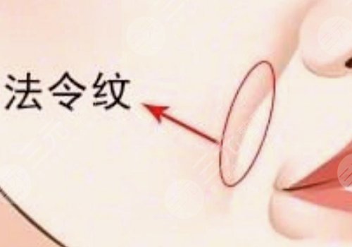 法令紋太深了有什么解決辦法？