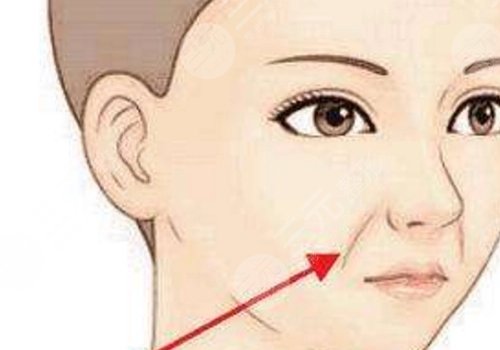 法令紋太深了有什么解決辦法？