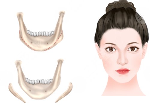 下頜角手術(shù)后頭套要戴多久？3-4周的時(shí)間？