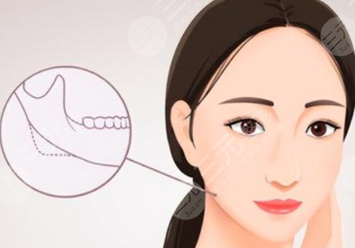 下頜角手術(shù)后頭套要戴多久？