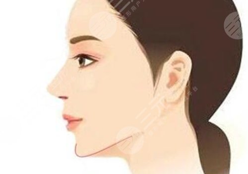 下頜角手術(shù)后頭套要戴多久？