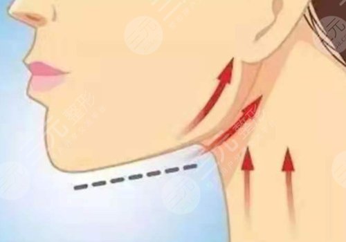 下頜緣提升怎么打？