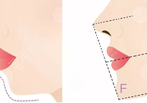 下頜緣提升怎么打？