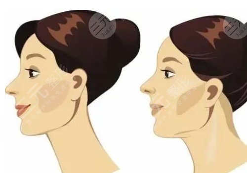 下頜緣提升怎么打？