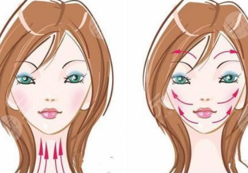 v臉繃帶提升有效果嗎？