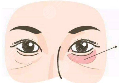 去黑眼圈和眼袋有效的方法是什么？眼周抗衰指南！