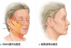 臉部拉皮手術(shù)有沒(méi)有危險(xiǎn)？幾種情況科普，了解之后再仔細(xì)考慮！