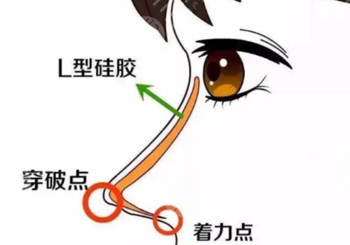 顧新安做鼻子怎樣