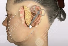 拉皮手術(shù)多少錢，拉皮手術(shù)費(fèi)用多少？參考價(jià)格給到、線雕/拉皮選擇