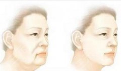 做大拉皮手術(shù)需要多少？了解拉皮適合年齡、維持時(shí)間|你適合嗎?