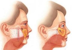 做拉皮手術(shù)有什么風(fēng)險(xiǎn)和副作用？做拉皮會(huì)老得更快嗎？相關(guān)知識(shí)解答
