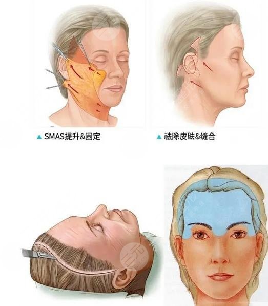 吳佳君迷你拉皮案例