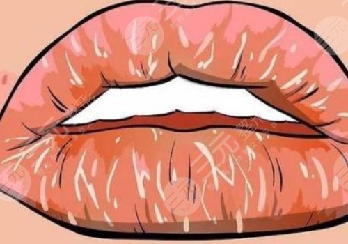 唇部老化的原因有哪些？唇部老化如何改良？