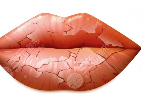 唇部老化的原因有哪些？唇部老化如何改良？