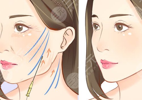 韌帶提升和拉皮的區(qū)別是什么？