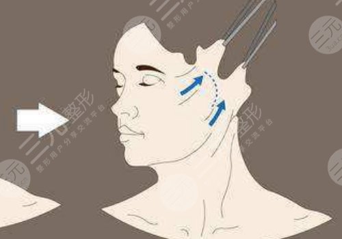 韌帶提升和拉皮的區(qū)別是什么？