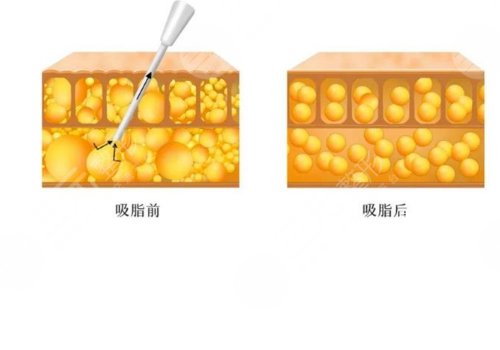 吸脂凹凸不平多久恢復(fù)？
