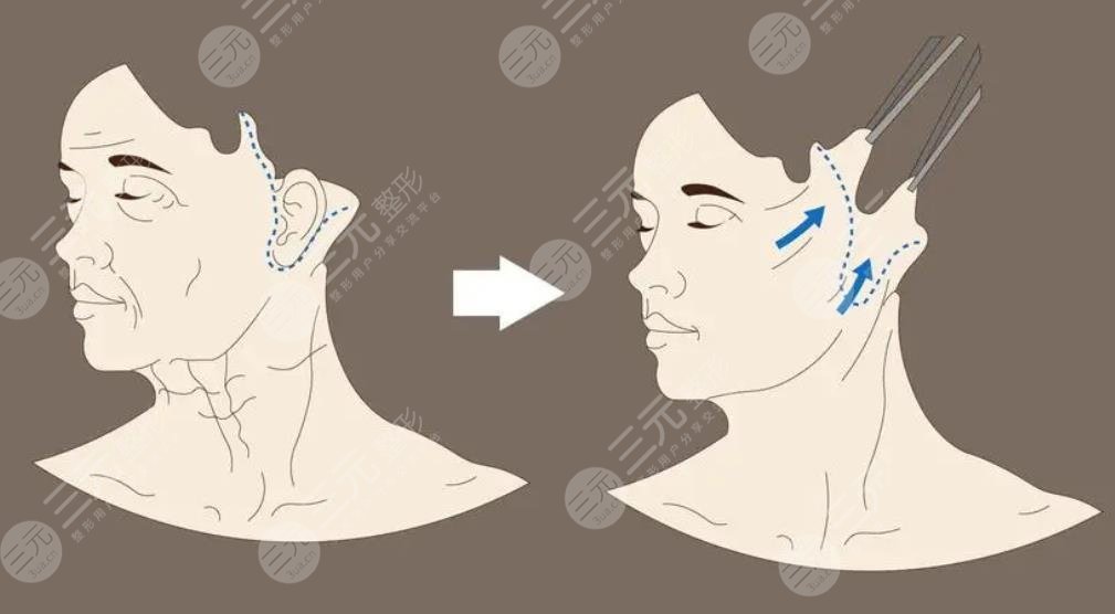 雙燕尾拉皮是怎么做