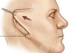 面部小拉皮術(shù)后多久可以拆線？7-10天傷口初步恢復(fù)可拆線~