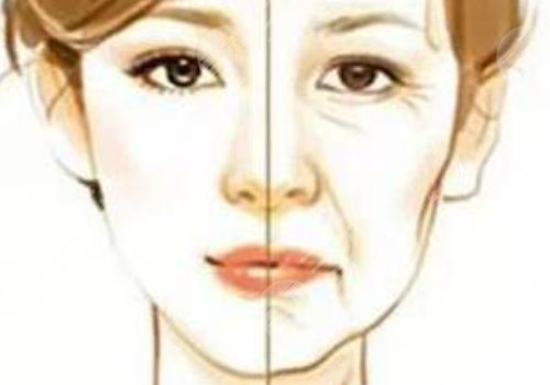 動(dòng)態(tài)紋和靜態(tài)紋哪個(gè)屬于真性皺紋？