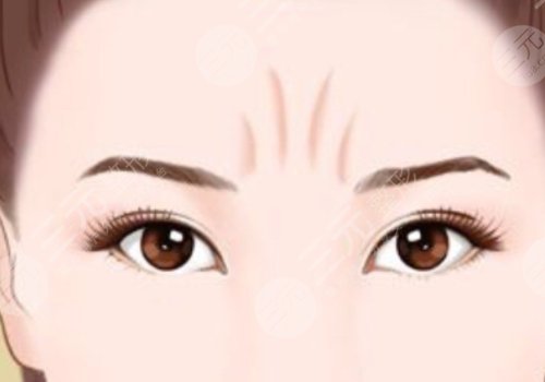 動(dòng)態(tài)紋和靜態(tài)紋哪個(gè)屬于真性皺紋？