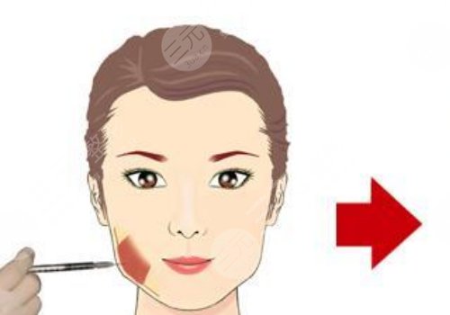 下頜緣提升有什么效果？