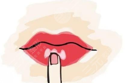 m唇整形一般多久拆線？術(shù)前小科普，這3件事你該了解！