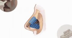 鼻子骨雕整形是什么原理，多少錢(qián)？珊瑚骨美鼻指南！