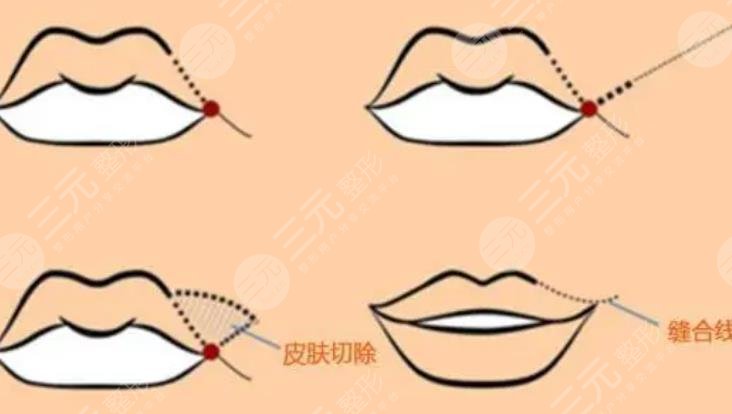 下唇厚外翻整形手術(shù)怎么做？科普及費(fèi)用價格參考！