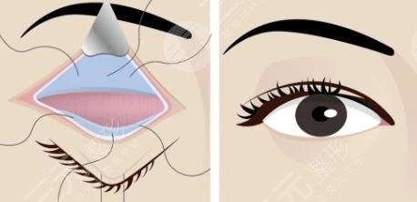 眼瞼下垂