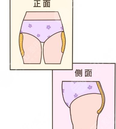 臀部兩側(cè)凸起怎么整形？吸脂體雕助你矯正不美臀型！