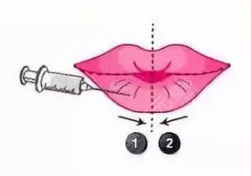 玻尿酸豐唇多久消腫？能維持多久？