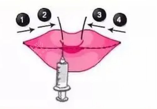 玻尿酸豐唇多久消腫？能維持多久？