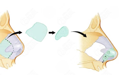 廣州市荔灣區(qū)人民醫(yī)院整形美容隆鼻怎么樣？