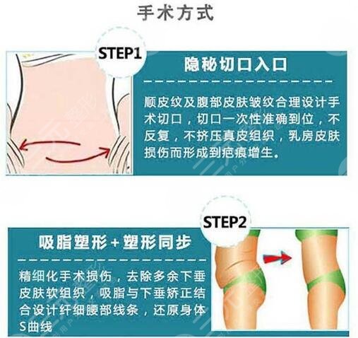 腰腹抽脂腹壁整形恢復(fù)期要多久？重塑小蠻腰，這些事你要知道！