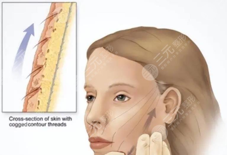 上海吳佳君醫(yī)生拉皮案例