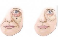 水剝離拉皮怎么做？原理介紹/手術(shù)注意要點(diǎn)可以了解清楚！