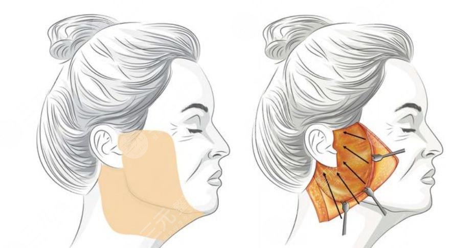 長春美奇醫(yī)院拉皮手術案例