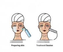 熱瑪吉和超聲炮的價格多少？兩者的原理介紹，對比一下再選擇！