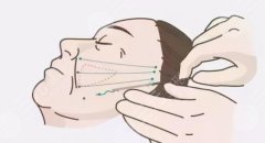 筋膜復(fù)位術(shù)和筋膜提升哪個好？原理對比分享，抗衰緊膚課堂！