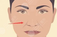 用什么填充法令紋好？3種常用材料講解，優(yōu)點對比！