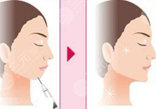 玻尿酸填充下巴有什么副作用？