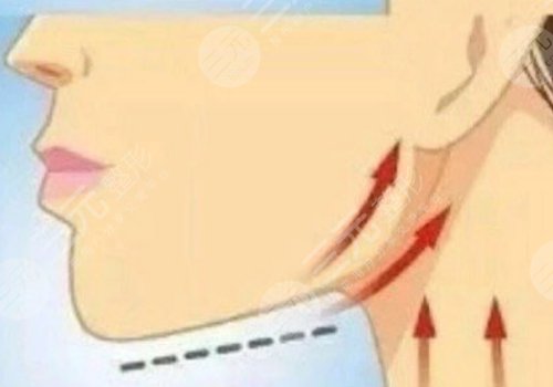 下頜線提升前后對(duì)比圖