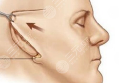 筋膜懸吊術(shù)適合多大年齡的？