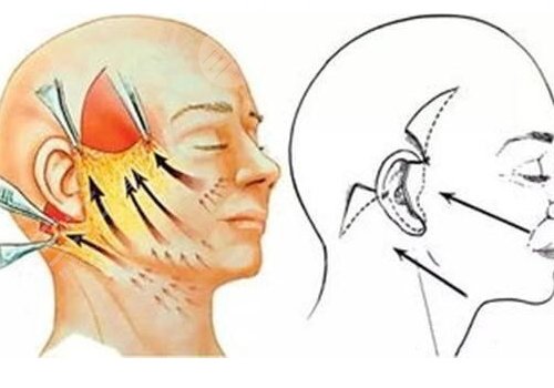 筋膜懸吊術(shù)適合多大年齡的？