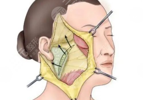 筋膜懸吊術(shù)適合多大年齡的？