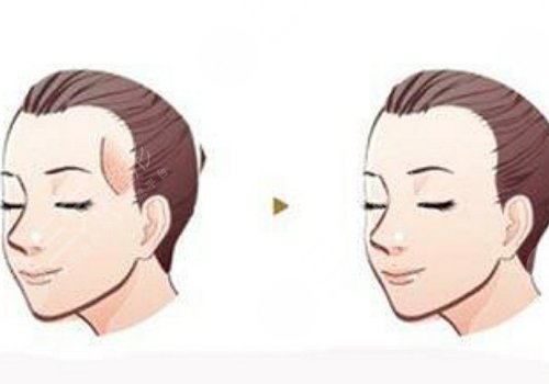 膠原蛋白填充太陽凹大概多少錢？